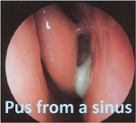 sinusitis