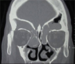 scan of sinus