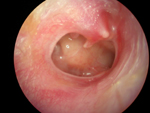 ear drum perforation