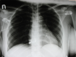 chest xray