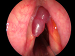 vocal cord nodules