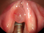 vocal cord polyp